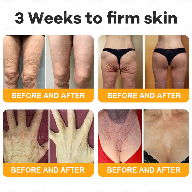 VLSVLS® Bee Venom Comprehensive Cream 💖💖LAST DAY 80% OFF (Sagging Skin, Fine Lines, Loss of Firmness, Flat Bust, Drooping Hips, and More)